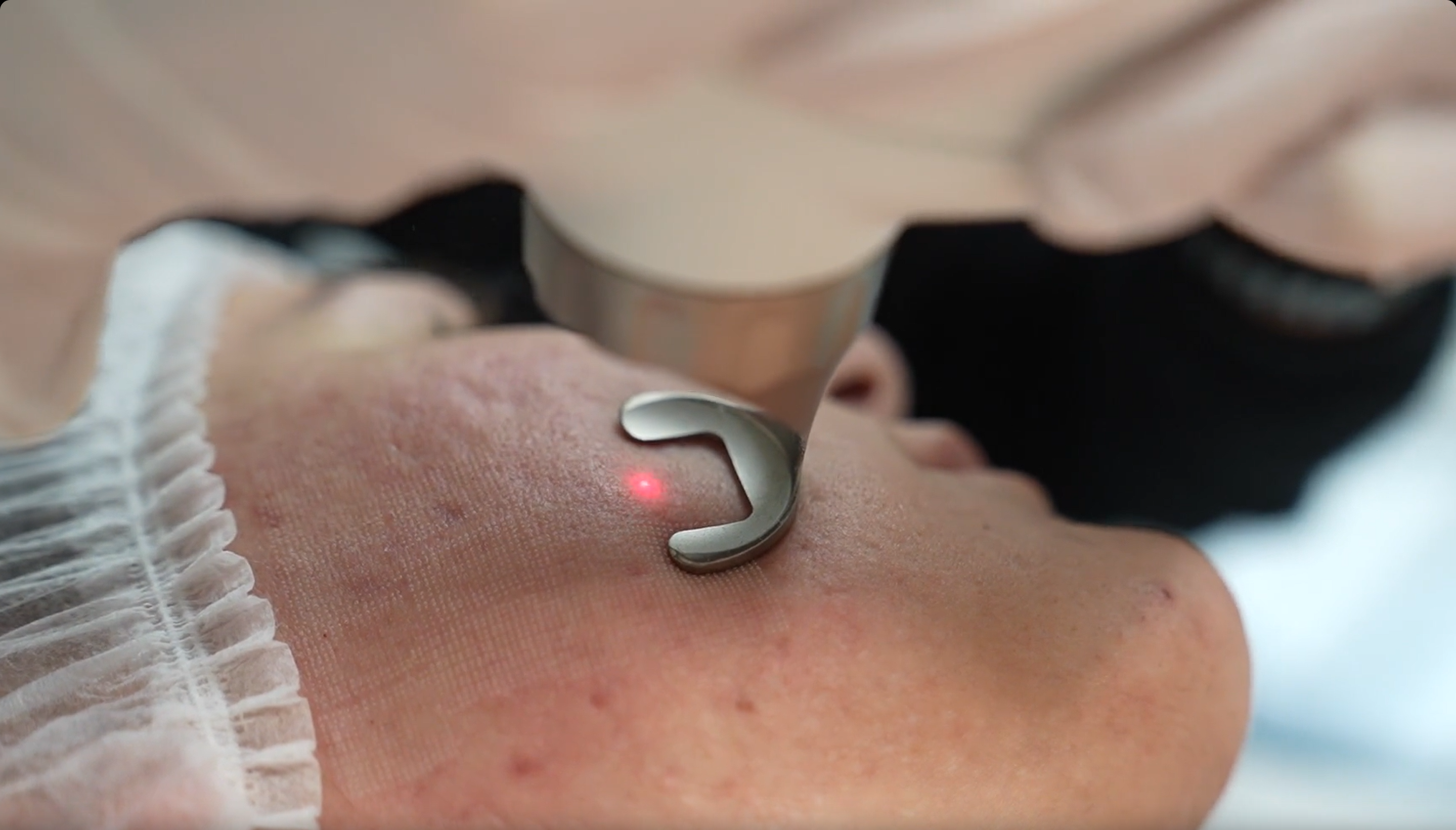 Fotona Laser Treatment