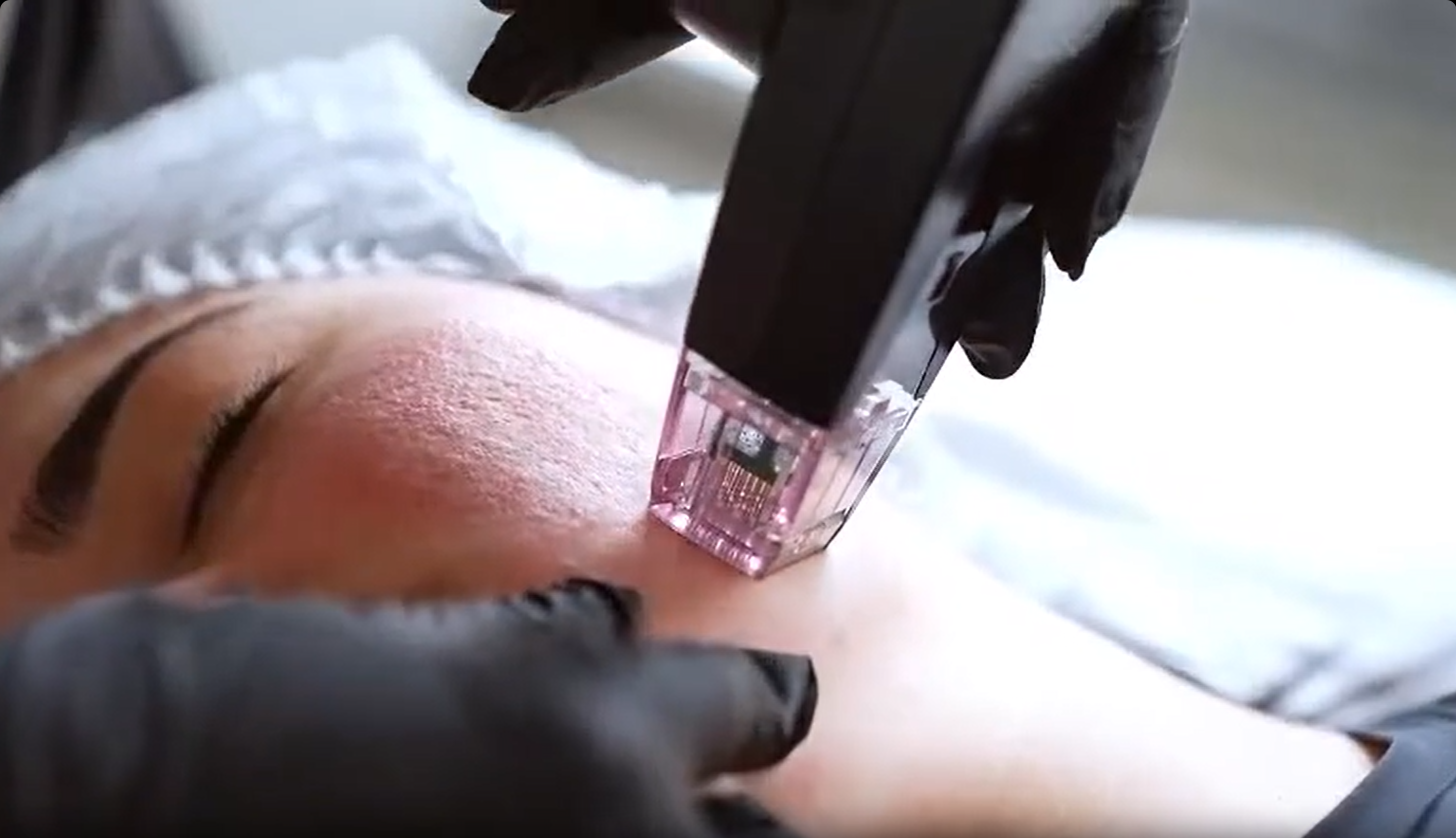 Morpheus8 – RF Microneedling for Acne Scars