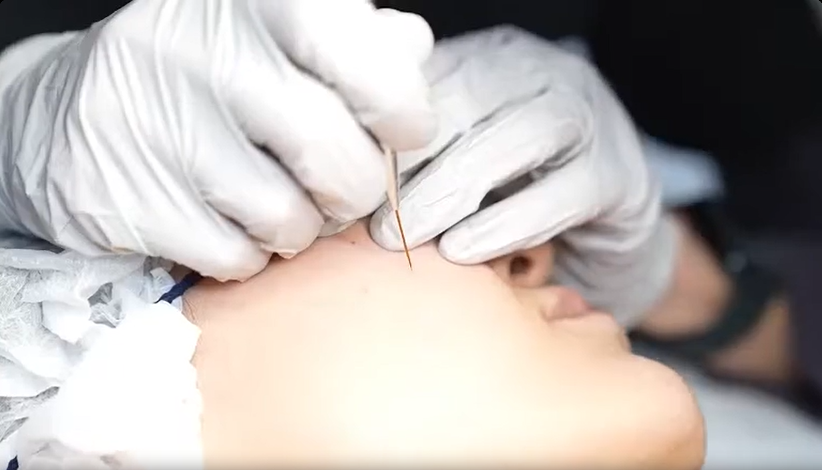 TCA CROSS for Scar Treatment