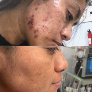 acne clinic