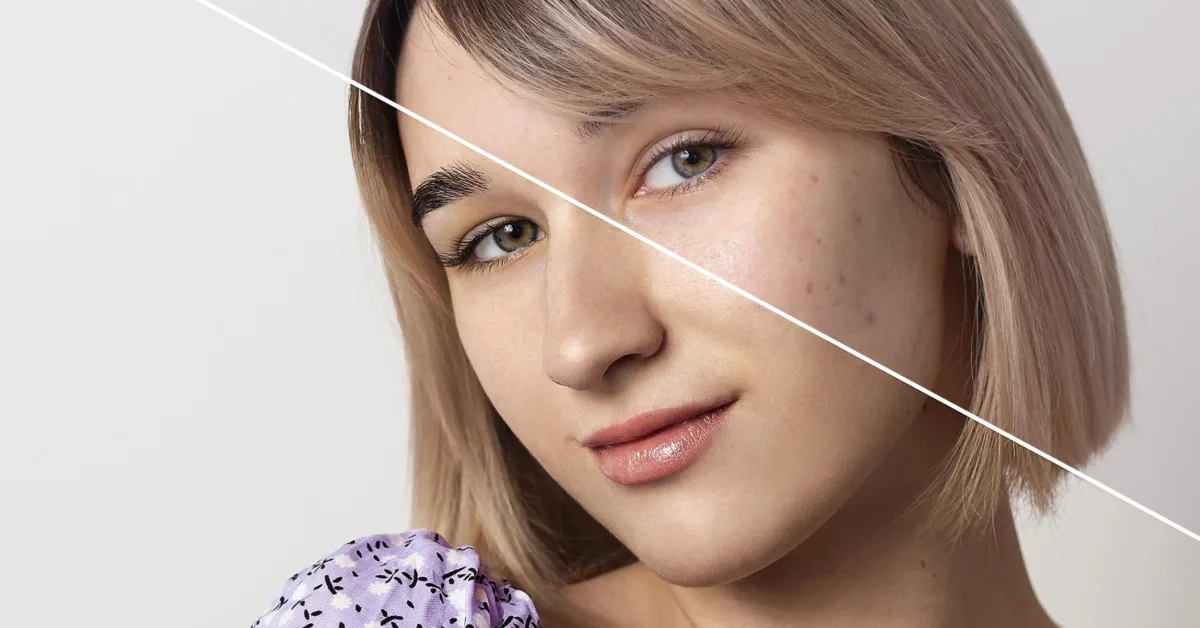 From Cystic Acne to Clear Skin: Real Transformation Story