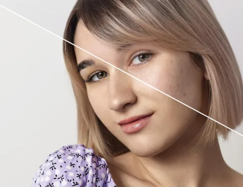 From Cystic Acne to Clear Skin: Real Transformation Story