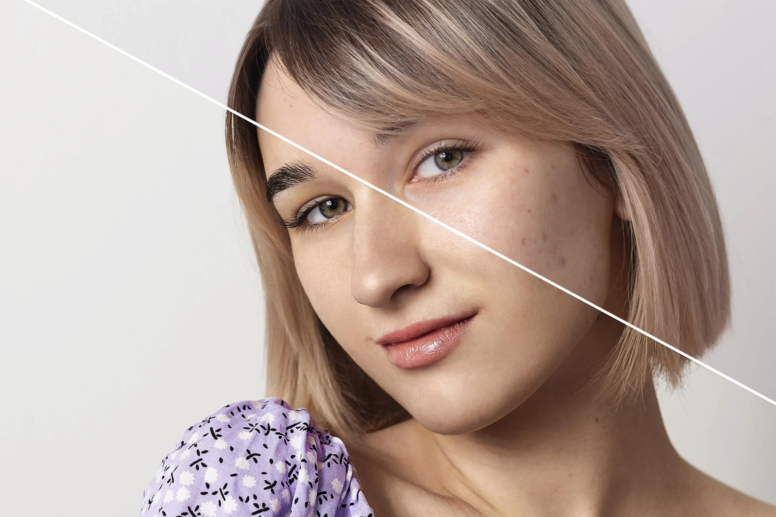 From Cystic Acne to Clear Skin: Real Transformation Story