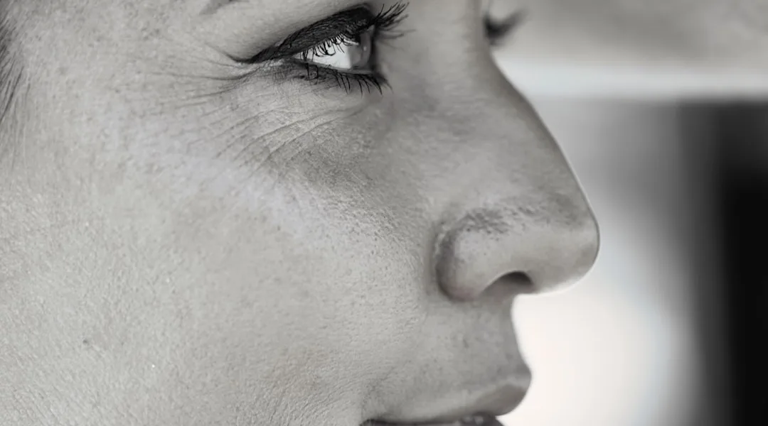 Cosmelan vs TCA CROSS: Best Treatments for Pigmentation & Acne Marks