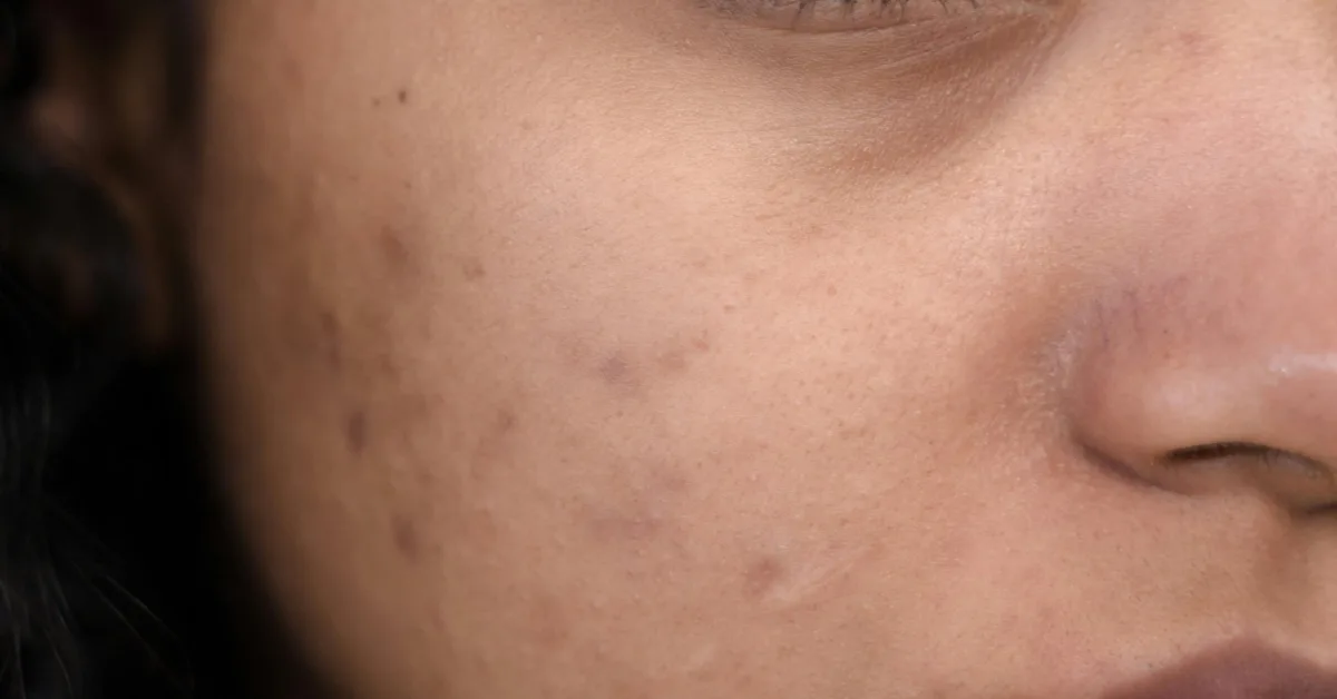 10 Proven Acne Scar Treatments Available at AcneClinicNYC