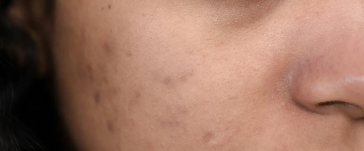 10 Proven Acne Scar Treatments Available at Acne Clinic NYC