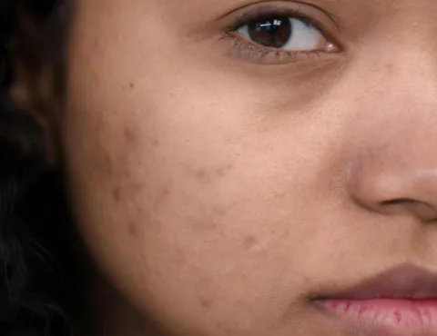 10 Proven Acne Scar Treatments Available at AcneClinicNYC