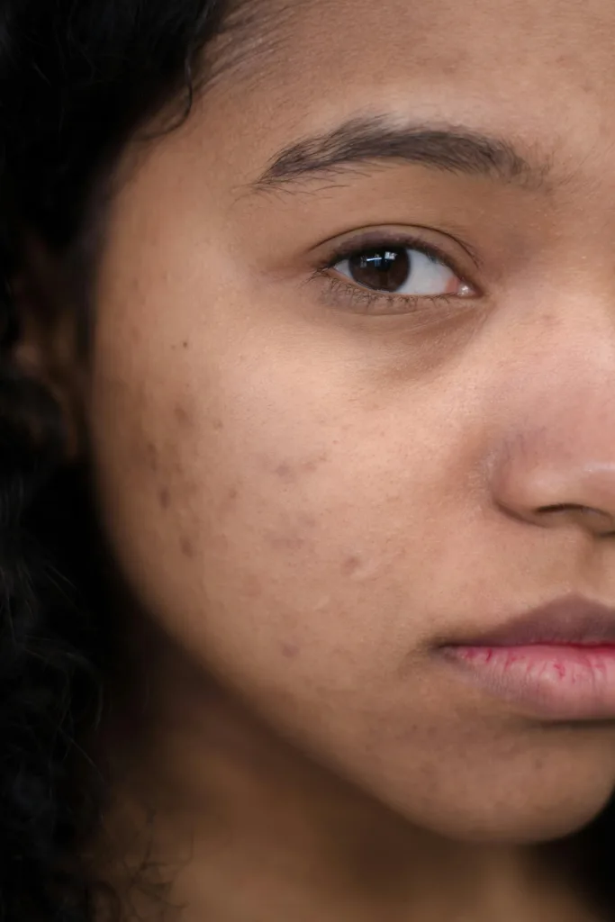 10 Proven Acne Scar Treatments Available at AcneClinicNYC